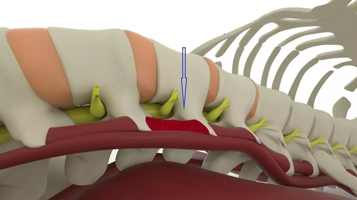 az ágyéki gyógyszerek kezelésére szolgáló osteochondrozis)